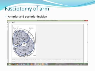 Fasciotomy of arm
- Anterior and posterior incision
 