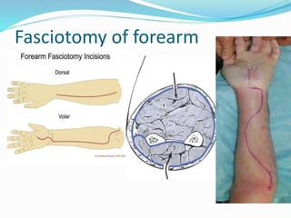 Fasciotomy of forearm
 