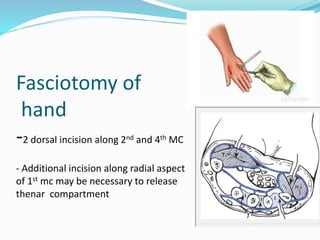 Fasciotomy of
hand
-2 dorsal incision along 2nd and 4th MC
- Additional incision along radial aspect
of 1st mc may be necessary to release
thenar compartment
 