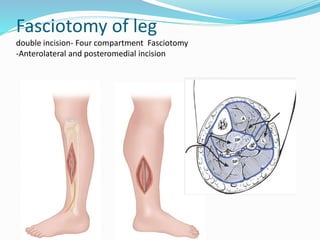 Fasciotomy of leg
double incision- Four compartment Fasciotomy
-Anterolateral and posteromedial incision
 