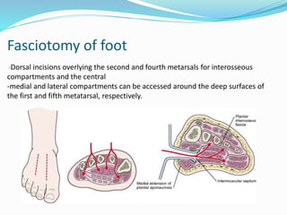 Fasciotomy of foot
-Dorsal incisions overlying the second and fourth metarsals for interosseous
compartments and the central
-medial and lateral compartments can be accessed around the deep surfaces of
the first and fifth metatarsal, respectively.
 