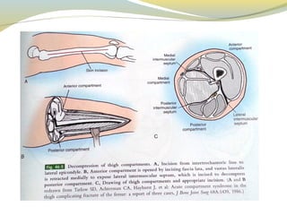 Compartment Sy Compartment syndrome | PPT