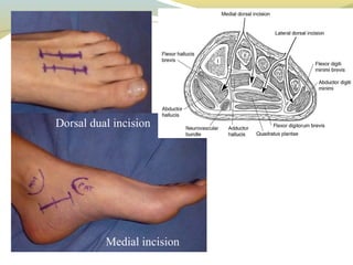 Dorsal Racket Incision Compartment syndrome | PPT