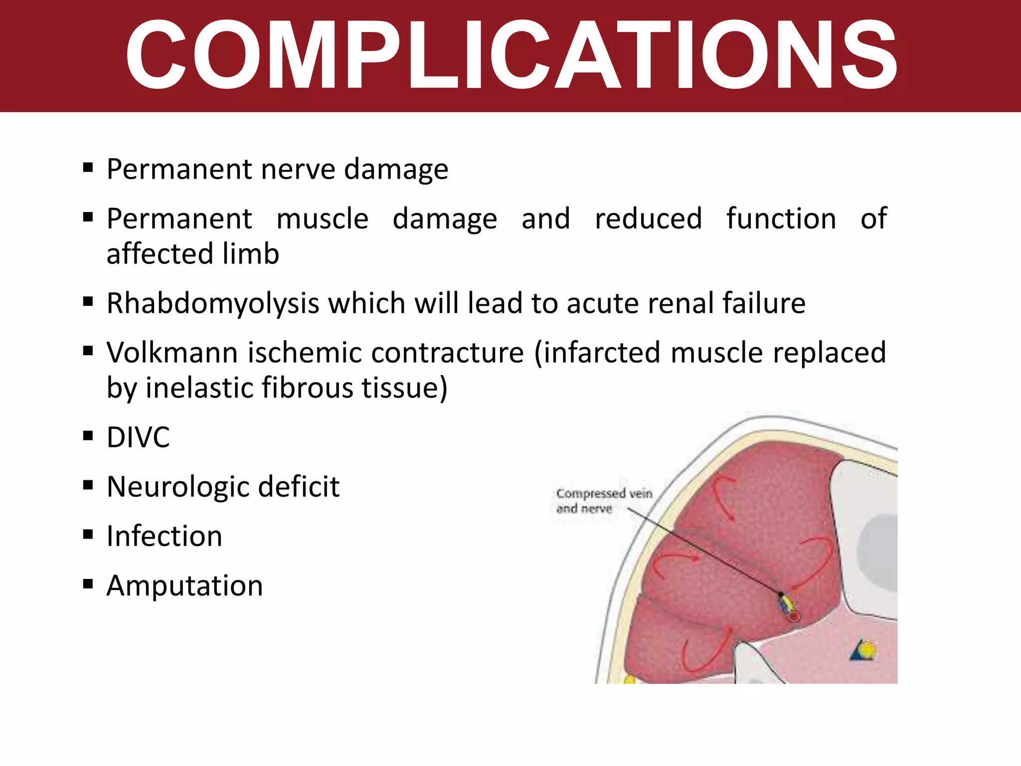 Compartment Syndrome Is A Potential Complication Of Infiltration