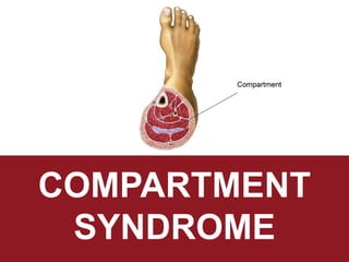 a u d i a f f a n h i d a y u l i y a n a h u s n a s a t i s h
COMPARTMENT
SYNDROME
 