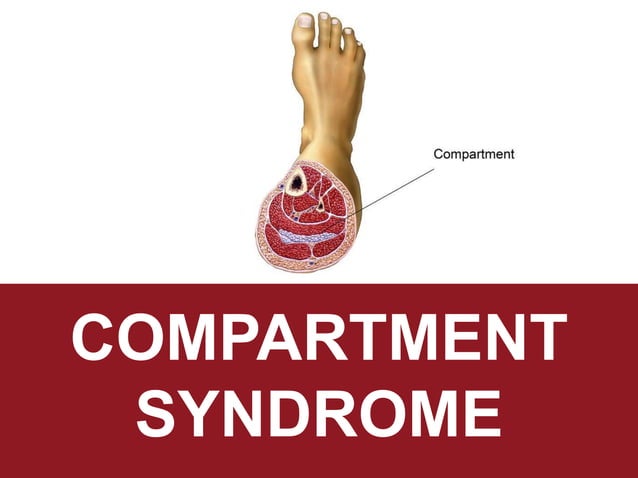 Compartment Sy Compartment syndrome | PPTX