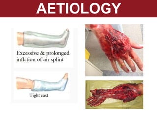 AETIOLOGY
 
