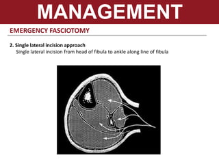 EMERGENCY FASCIOTOMY
2. Single lateral incision approach
Single lateral incision from head of fibula to ankle along line of fibula
MANAGEMENT
 