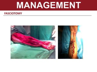 FASCIOTOMY
MANAGEMENT
 