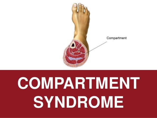 compartment syndrome compartment syndrome