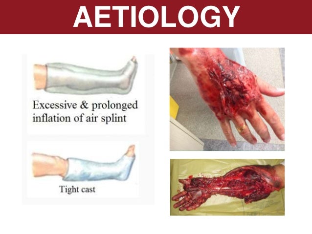 compartment syndrome compartment syndrome