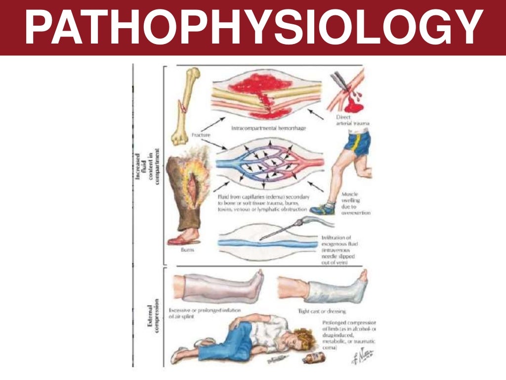 Compartment syndrome