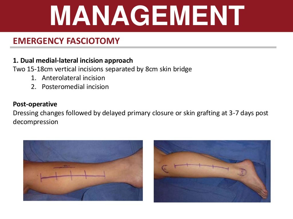 Compartment syndrome