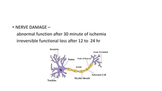 • NERVE DAMAGE –
abnormal function after 30 minute of ischemia
irreversible functional loss after 12 to 24 hr
 