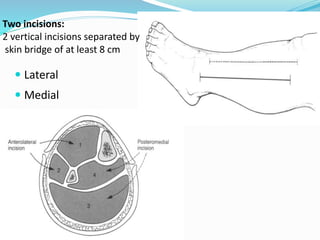 Two incisions:
2 vertical incisions separated by
skin bridge of at least 8 cm
 Lateral
 Medial
 