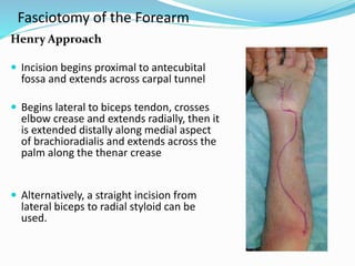 Fasciotomy of the Forearm
Henry Approach
 Incision begins proximal to antecubital
fossa and extends across carpal tunnel
 Begins lateral to biceps tendon, crosses
elbow crease and extends radially, then it
is extended distally along medial aspect
of brachioradialis and extends across the
palm along the thenar crease
 Alternatively, a straight incision from
lateral biceps to radial styloid can be
used.
 