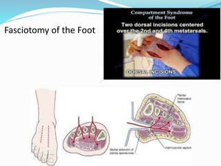 Fasciotomy of the Foot
 