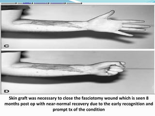 Skin graft was necessary to close the fasciotomy wound which is seen 8
months post op with near-normal recovery due to the early recognition and
prompt tx of the condition
 