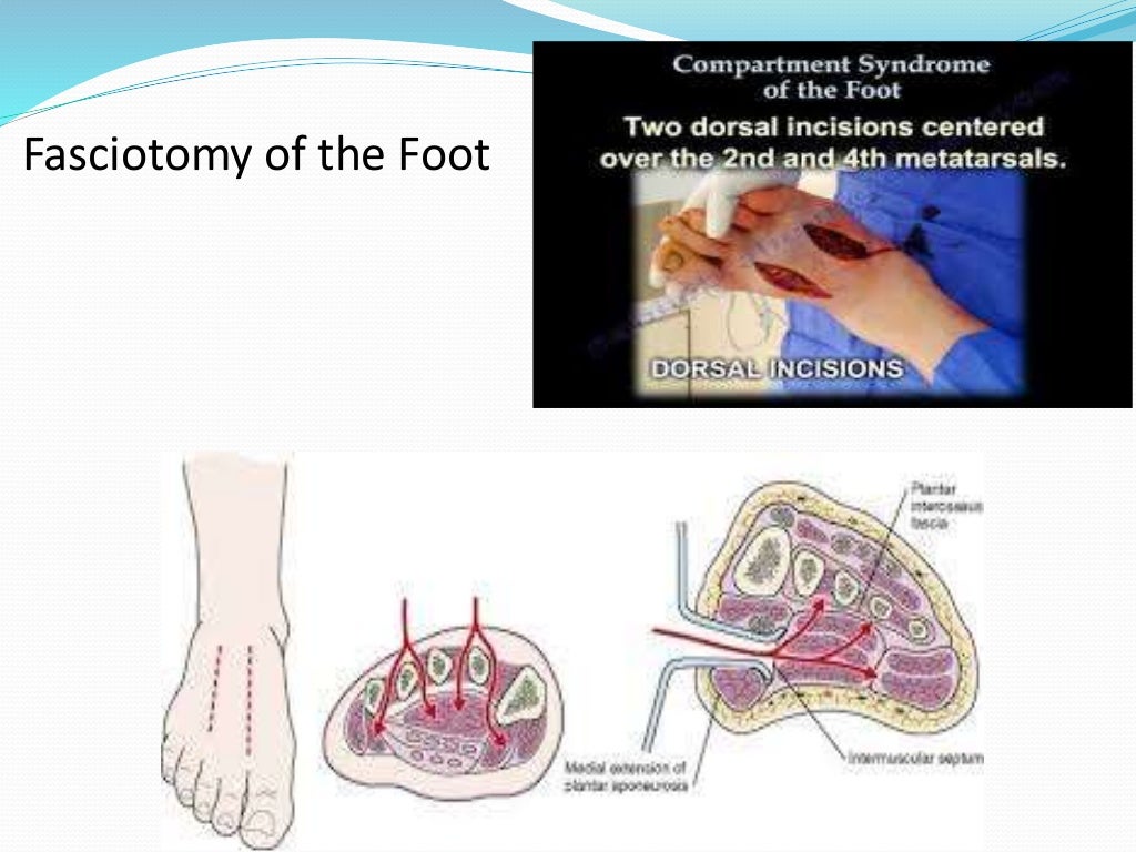 Compartment syndrome