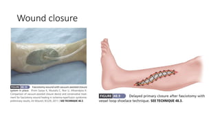 Wound closure
 