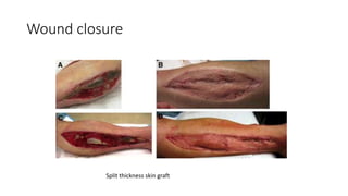 Wound closure
Split thickness skin graft
 