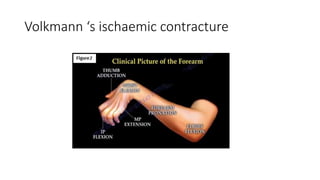 Volkmann ‘s ischaemic contracture
 