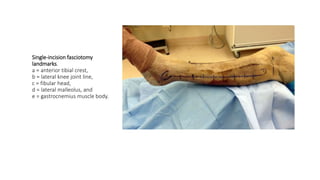 Single-incision fasciotomy
landmarks.
a = anterior tibial crest,
b = lateral knee joint line,
c = fibular head,
d = lateral malleolus, and
e = gastrocnemius muscle body.
 