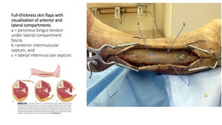 Full-thickness skin flaps with
visualization of anterior and
lateral compartments.
a = peroneus longus tendon
under lateral compartment
fascia,
b =anterior intermuscular
septum, and
c = lateral intermuscular septum.
 