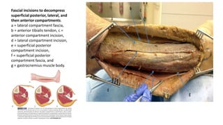 Fascial incisions to decompress
superficial posterior, lateral, and
then anterior compartments.
a = lateral compartment fascia,
b = anterior tibialis tendon, c =
anterior compartment incision,
d = lateral compartment incision,
e = superficial posterior
compartment incision,
f = superficial posterior
compartment fascia, and
g = gastrocnemius muscle body.
 