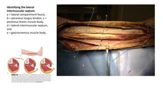 Identifying the lateral
intermuscular septum.
a = lateral compartment fascia,
b = peroneus longus tendon, c =
peroneus brevis muscle body,
d = lateral intermuscular septum,
and
e = gastrocnemius muscle body.
 