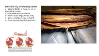 Entrance to deep posterior compartment.
a = posterior border of fibula and site of
longitudinal incision,
b = lateral intermuscular septum,
c = flexor hallucis longus muscle body,
d = peroneus longus muscle body, and
e = fascia overlying lateral compartment
 