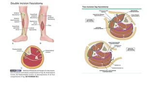 Double incision Fasciotomy
 