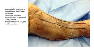 Landmarks for anterolateral
skin incision in dual-incision
fasciotomy.
a = anterior tibial crest,
b = anterolateral skin incision,
c = fibular head,
d = lateral knee joint line, and
e = tibiotalar joint.
 