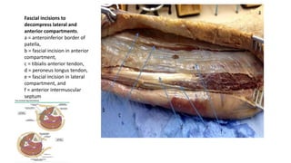 Fascial incisions to
decompress lateral and
anterior compartments.
a = anteroinferior border of
patella,
b = fascial incision in anterior
compartment,
c = tibialis anterior tendon,
d = peroneus longus tendon,
e = fascial incision in lateral
compartment, and
f = anterior intermuscular
septum
 