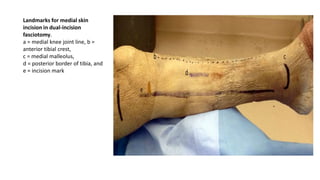 Landmarks for medial skin
incision in dual-incision
fasciotomy.
a = medial knee joint line, b =
anterior tibial crest,
c = medial malleolus,
d = posterior border of tibia, and
e = incision mark
 