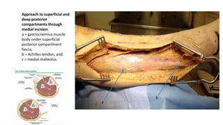 Approach to superficial and
deep posterior
compartments through
medial incision.
a = gastrocnemius muscle
body under superficial
posterior compartment
fascia,
b = Achilles tendon, and
c = medial malleolus.
 