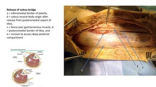 Release of soleus bridge.
a = inferomedial border of patella,
b = soleus muscle body origin after
release from posteromedial aspect of
tibia,
c = fascia over gastrocnemius muscle, d
= posteromedial border of tibia, and
e = incision to access deep posterior
compartment
 