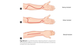 Henry incision
Ulnar incision
Dorsal incision
 