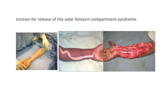 Incision for release of the volar forearm compartment syndrome.
 