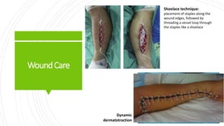 WoundCare
Shoelace technique:
placement of staples along the
wound edges, followed by
threading a vessel loop through
the staples like a shoelace
Dynamic
dermatotraction
 