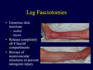 Leg Fasciotomies
• Generous skin
incisions
– medial
– lateral
• Release completely
all 4 fascial
compartments
• Beware of
neurovascular
structures to prevent
iatrogenic injury
 