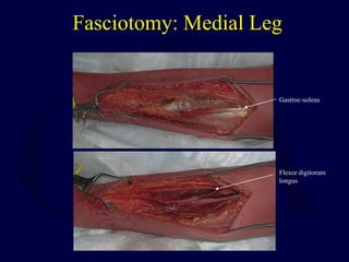 Fasciotomy: Medial Leg
Flexor digitorum
longus
Gastroc-soleus
 