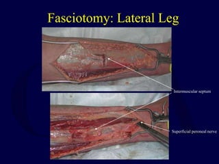 Fasciotomy: Lateral Leg
Superficial peroneal nerve
Intermuscular septum
 