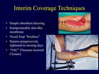 Interim Coverage Techniques
• Simple absorbent dressing
• Semipermeable skin-like
membrane
• Vessel loop “bootlace”
• Sutures progressively
tightened in ensuing days
• “VAC” (Vacuum Assisted
Closure)
 