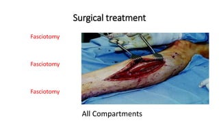 Surgical treatment
Fasciotomy
Fasciotomy
Fasciotomy
All Compartments
 