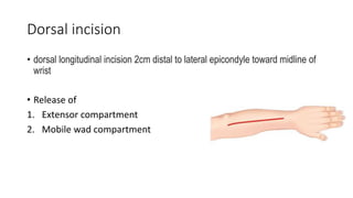 Dorsal incision
• dorsal longitudinal incision 2cm distal to lateral epicondyle toward midline of
wrist
• Release of
1. Extensor compartment
2. Mobile wad compartment
 