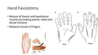 Hand Fasciotomy
• Release of thenar and hypothenar
muscles by making palmar radial and
dorsal incisions.
• Midaxial incision of fingers
 
