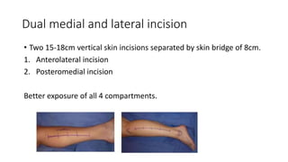 Dual medial and lateral incision
• Two 15-18cm vertical skin incisions separated by skin bridge of 8cm.
1. Anterolateral incision
2. Posteromedial incision
Better exposure of all 4 compartments.
 