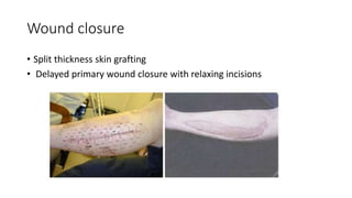 Wound closure
• Split thickness skin grafting
• Delayed primary wound closure with relaxing incisions
 