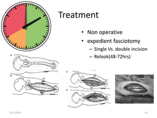 Treatment
• Non operative
• expedient fasciotomy
– Single Vs. double incision
– Relook(48-72hrs)
3/11/2024 43
 
